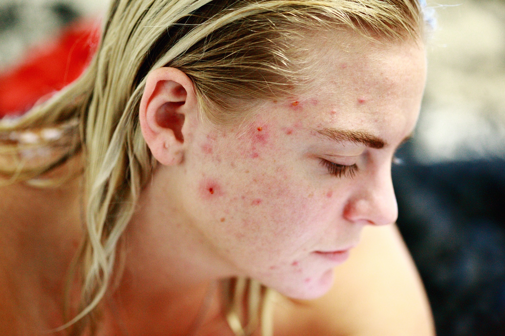 Acne piora no verão! Descubra como se livra das espinhas e cravos