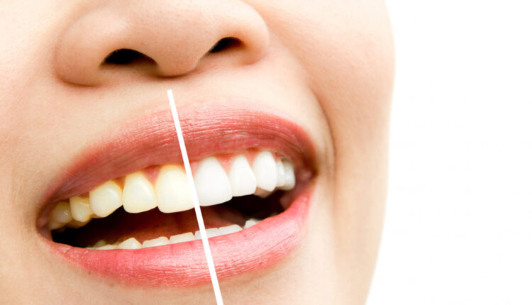 Receita indígena para clarear os dentes IMPRESSIONA; veja como é