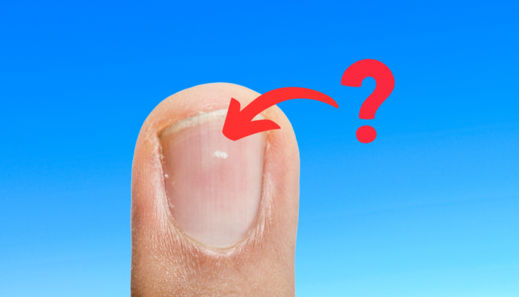 Entre superstições e lendas urbanas por trás das manchas brancas nas unhas, uma verdade mais séria pode estar sendo, enfim, sendo mostrada. O corpo costuma dar sinais de que a saúde de uma forma geral não está totalmente equilibrada, e o mesmo funciona com a unha, que fornece pistas e até mesmo alertas sobre possíveis condições camufladas por meio de sua aparência. Saiba mais detalhes sobre as origens das chamadas 'manchas' nas unhas, logo abaixo.