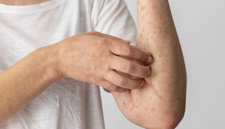 Subestimada por muitos, a alergia alimentar é uma resposta imunológica anormal do sistema do corpo a certos alimentos, se transformando em uma reação inadequada do sistema imunológico, que identificam alimentos como ameaças potenciais. Tal tipo de alteração no organismo humano pode se transformar em doenças mais sérias e até mesmo colocar em risco a vida da pessoa.