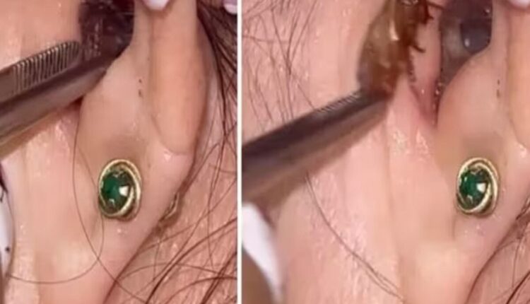 Para quem está sempre atento às novidades que surgem nas redes sociais, seja de qual assunto for, um vídeo viralizou no TikTok, ao mostrar uma médica colombiana realizando a remoção de uma barata do ouvido de uma paciente. Continue a leitura para saber mais detalhes sobre a assustadora situação e entenda os riscos de insetos entrarem em seu ouvido.