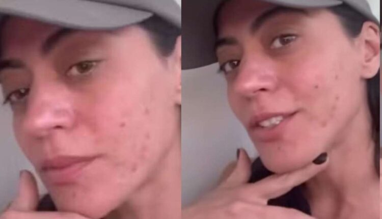 Clarice de 'Garota do Momento', Carol Castro tem doença crônica; médica alerta sobre diagnóstico e cuidados: 'É recomendável evitar...'