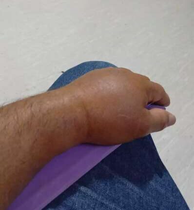 Moto entregador aguarda cirurgia no punho há uma semana